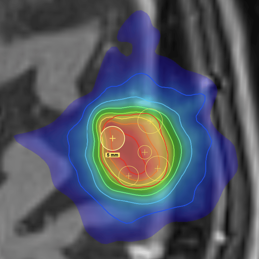 ZAP Surgical Systems